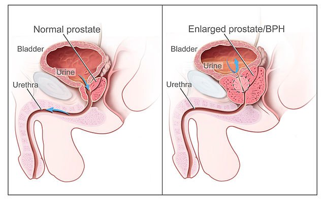 Prostate-Enlargement